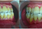 [Bệnh viện Răng Hàm Mặt TW] Đánh giá hiệu quả của Kháng thể IgY với bệnh viêm quanh răng