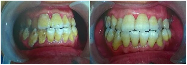 [Bệnh viện Răng Hàm Mặt TW] Đánh giá hiệu quả của Kháng thể IgY với bệnh viêm quanh răng 3