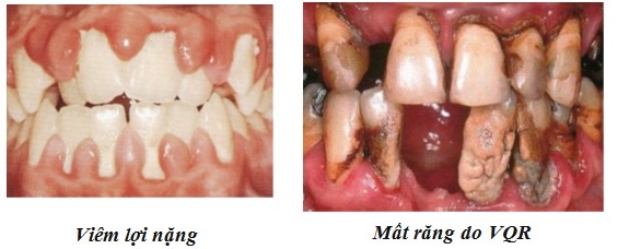 Các loại bệnh quanh răng thường gặp 1