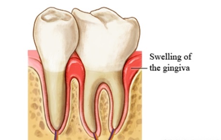 Xỉa răng có thể gây viêm lợi (nướu), hôi miệng 1