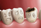 Tìm hiểu về bệnh sâu răng