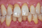 Các nguyên nhân gây bệnh viêm quanh răng