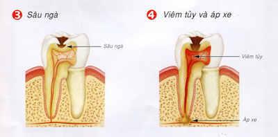 3.4. Phân loại thể sâu răng ở trẻ em thường gặp 3