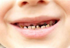 Dự phòng sâu răng cho trẻ nhỏ