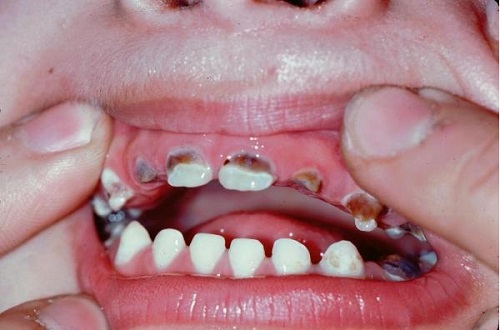 3.4. Phân loại thể sâu răng ở trẻ em thường gặp 1