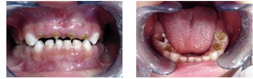 3.4. Phân loại thể sâu răng ở trẻ em thường gặp 2