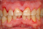Những điều cần biết về bệnh quanh răng