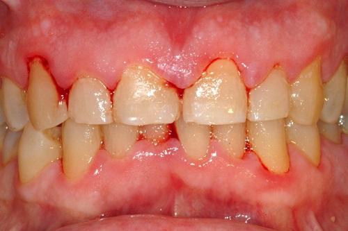 Những điều cần biết về bệnh quanh răng 1