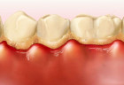 [Tạp chí JOS- Nhật Bản] Nghiên cứu tác dụng Ovalgen PG trên bệnh quanh răng
