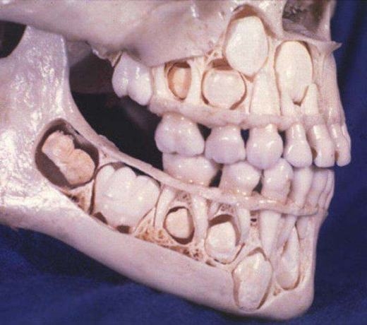 Răng sữa sẽ mất đi và không ảnh hưởng đến răng vĩnh viễn 1