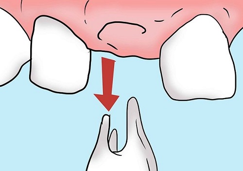 Biểu hiện của viêm chân răng 1