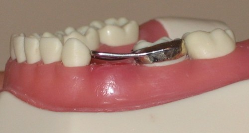 Sâu răng hàm ở trẻ em - đơn giản nhưng nguy hiểm 1