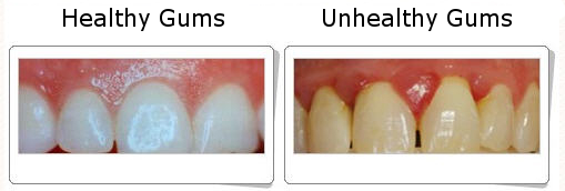 Dấu hiệu viêm nướu răng 1