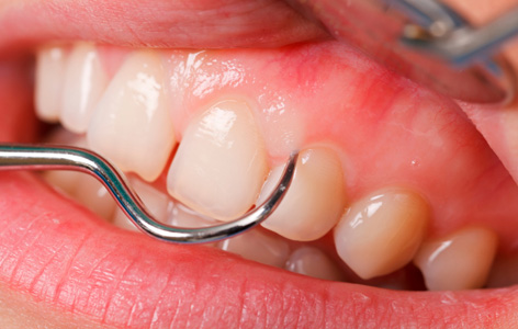 Biểu hiện của bệnh viêm nướu răng 1