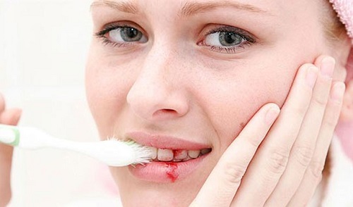 Chảy máu chân răng là bệnh gì? 1