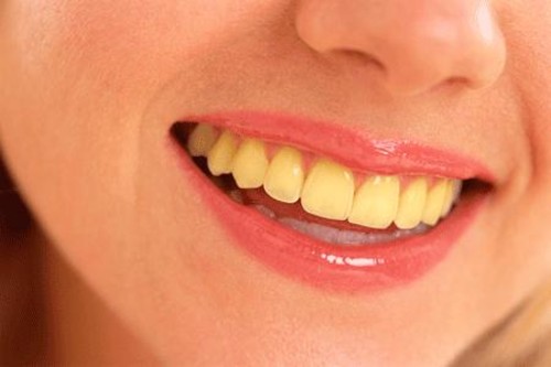 Nguyên nhân nào khiến răng bị vàng ố 1
