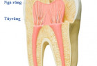 Nguyên nhân và cách điều trị viêm tủy răng