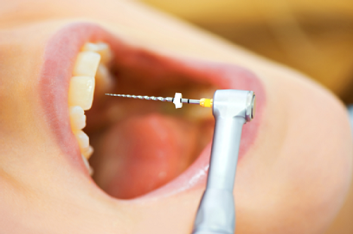 Triệu chứng viêm tủy răng 1