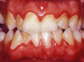 Các bệnh lý răng miệng như viêm lợi - viêm nha chu, sâu răng,.. là một trong những nguyên nhân chính gây hôi miệng