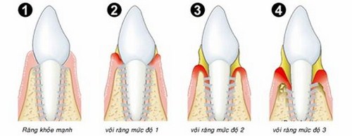 Nguyên nhân gây bệnh sâu răng và các giai đoạn phát triển 1