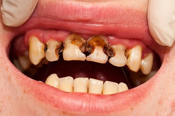 Làm gì khi răng sữa của trẻ bị sâu? 1