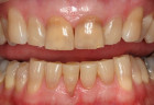 Bị mòn chiếc răng và ố vàng có dùng được Kháng thể IgY không?