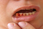 Bị chảy máu chân răng là biểu hiện của bệnh gì?