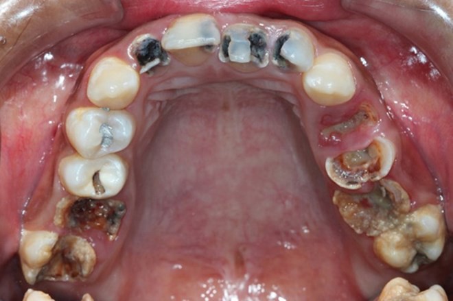 Bệnh sâu răng có chữa được không? 1