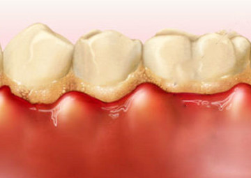 Chảy máu chân răng: dấu hiệu nguy hiểm của bệnh viêm lợi