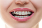 Chăm sóc răng miệng trong thời kì niềng răng như thế nào?
