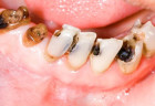 Nguyên nhân sâu răng và cách phòng ngừa cơ bản