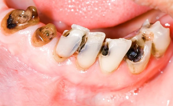 Nguyên nhân sâu răng và cách phòng ngừa cơ bản 1